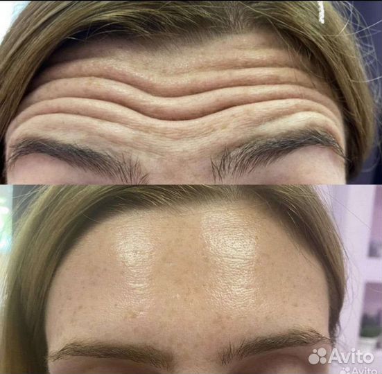 День ботокса Релатокс