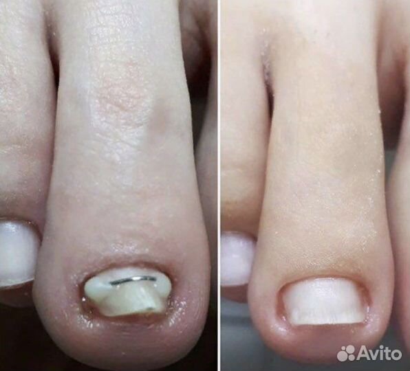 Подолог лечебный педикюр титановая нить грибок