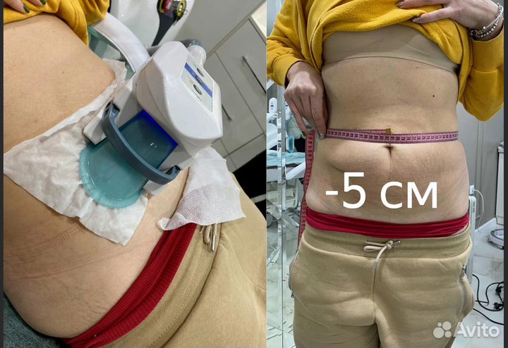 Удаление жира, криолиполиз в Перми