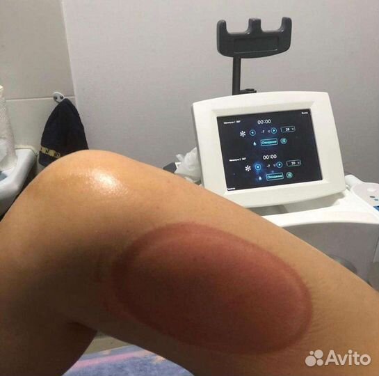 Криолиполиз самая эффективная методика похудения