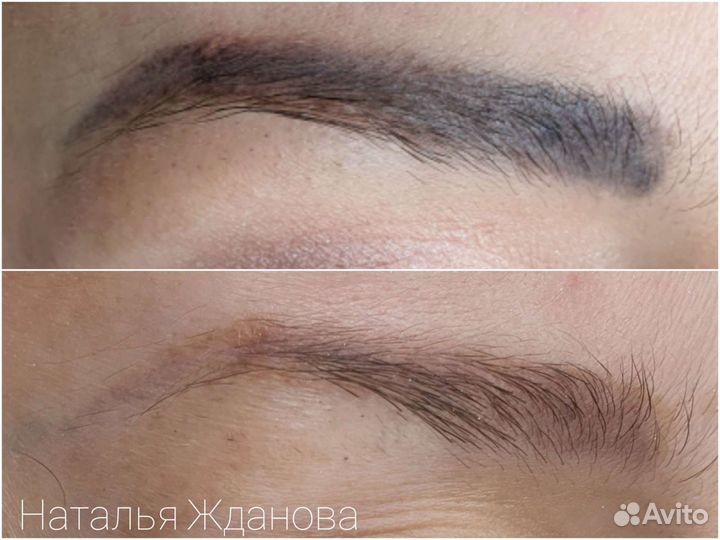 Удаление татуажа перманентного макияжа