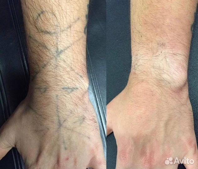 Удаление тату татуажа любых цветов