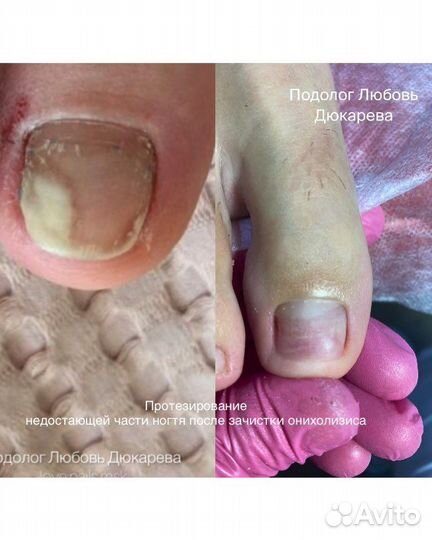 Подолог Медицинский педикюр Вросший ноготь