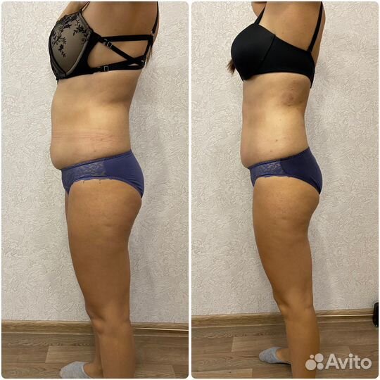 Массаж ручной и аппаратный LPG