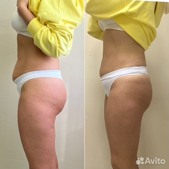 Липосоникс liposonix
