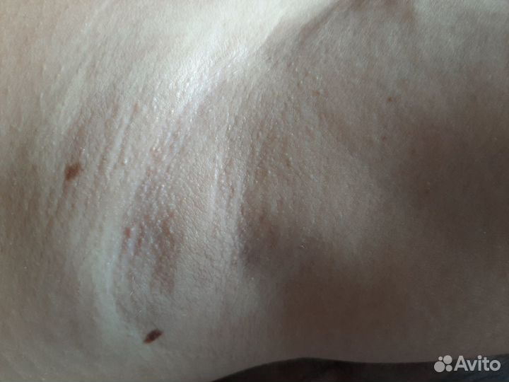 Электроэпиляция, гелинг-эпиляция