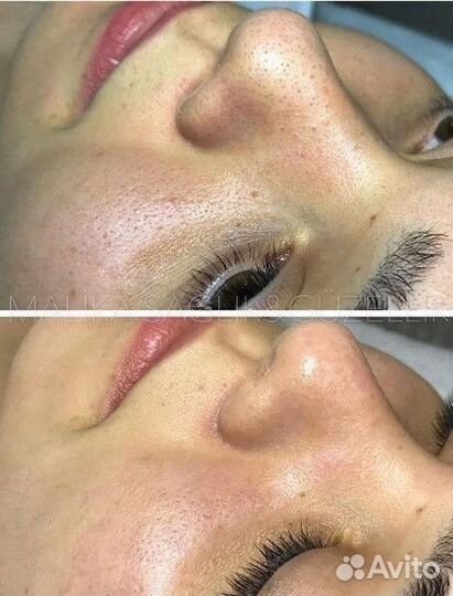 Косметолог чистка лица