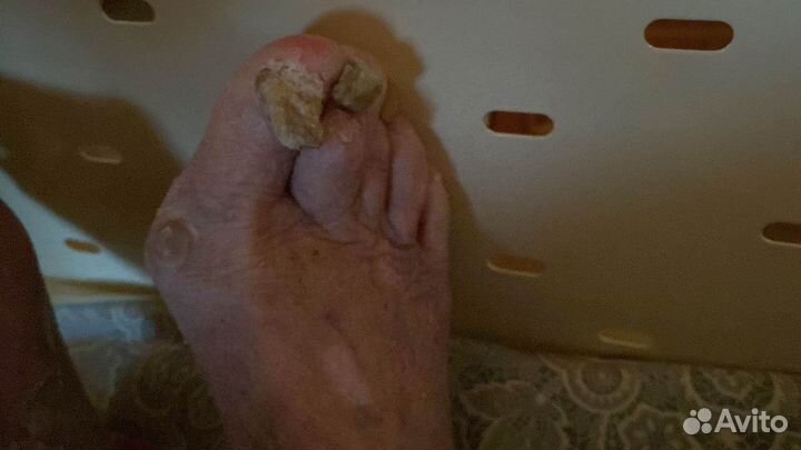 Медицинский педикюр аппаратный. Выезд на дому