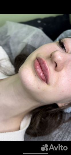 Увеличение губ/ Ботокс /Наращивание ресниц