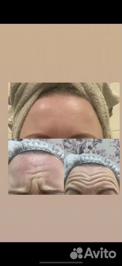 Косметолг Ботокс /бьютификация /липолитики