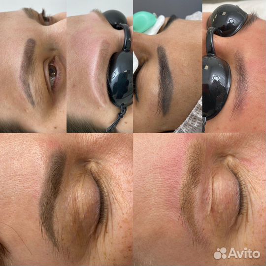 Удаление татуажа и тату