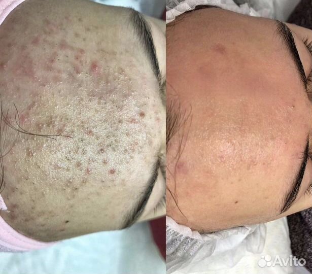 Чистка лица