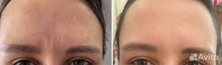 Ботулинотерапия модели