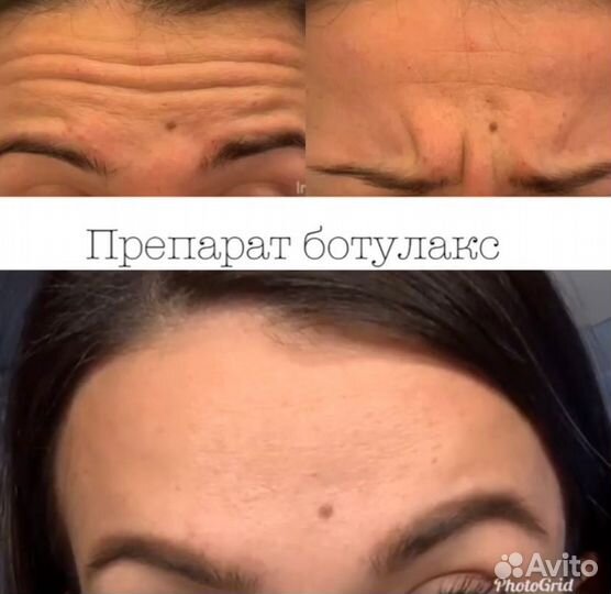 Ботокс в лоб+межбровье+глаза от врача-косметолога