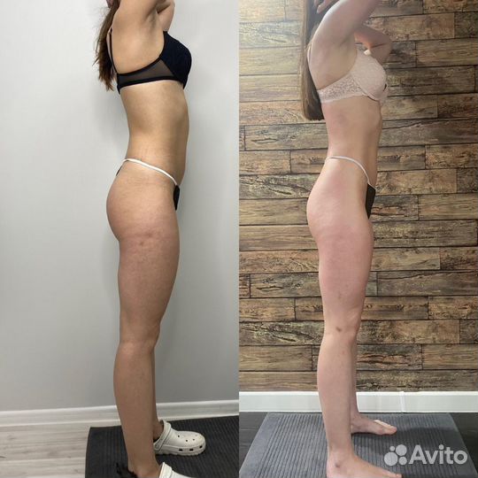 Антицеллюлитный/лимфодренажный массаж