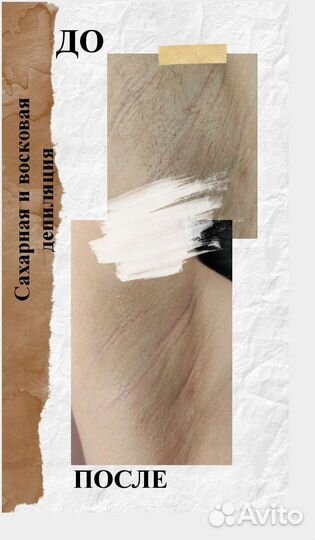 Шугаринг эпиляция