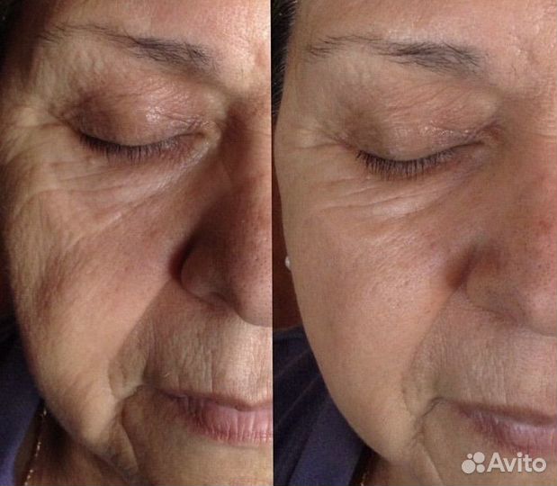 Фракционная мезотерапия