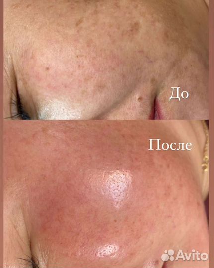 Плазмолифтинг