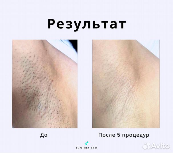 Диодный лазер для эпиляции Lumines Max’One 1200вт