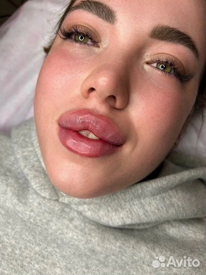 Карбокситерапия