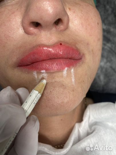 Ботокс для лица