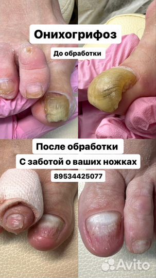 Подолог, изготовление стелек