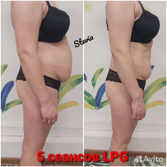 Lpg массаж м.Московская