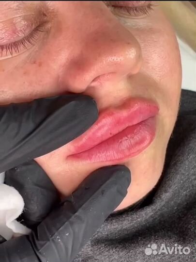 Увеличение губ