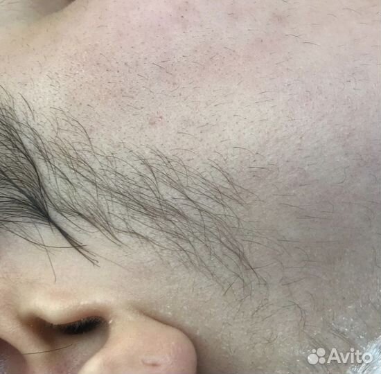 Обучение электроэпиляции