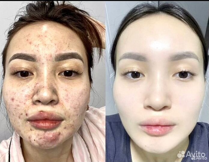 Ищу модель на чистое лицо (heleo 4 )