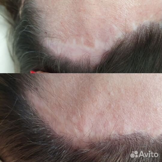 Дермопигментация, камуфляж шрамов