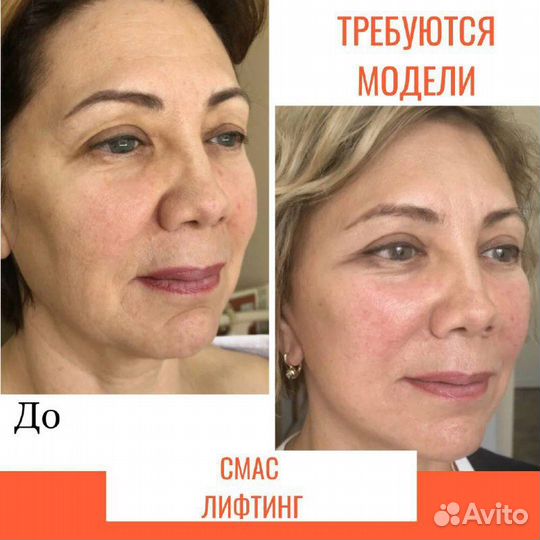 Модель на смас лифтинг
