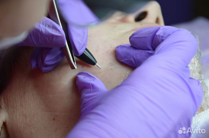 Электроэпиляция