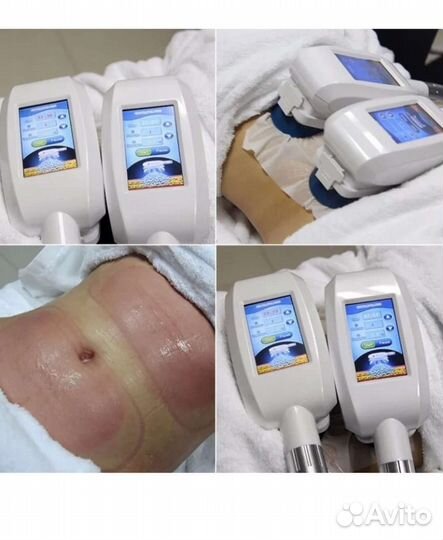 Криолиполиз