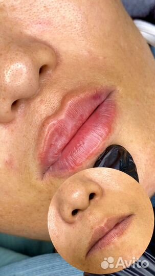 Ботулинотерапия