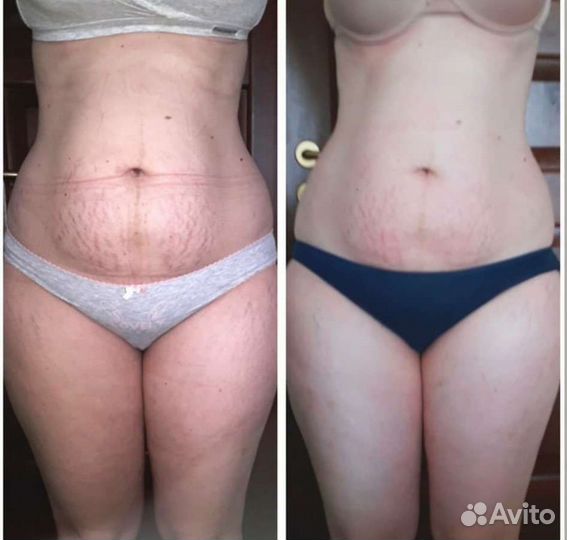 Антицеллюлитный массаж, аппаратный