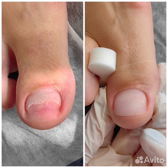 Протезирование ногтей, Титановая нить, педикюр