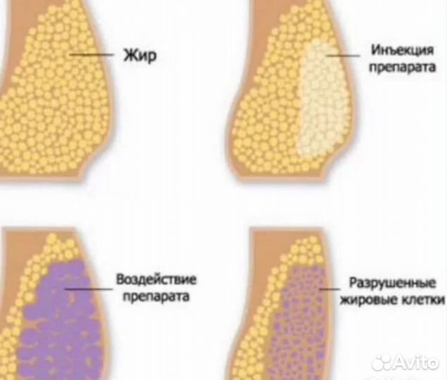 Модель на липолитики, «Королевская талия»