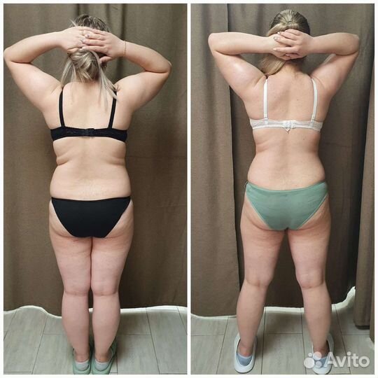 Криолиполиз, кавитация, ваккумный массаж