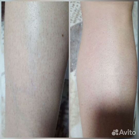 Депиляция воском: верхняя губа