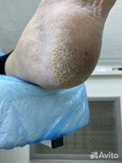 Подолог/Педикюр/Вросший ноготь/Мозоль