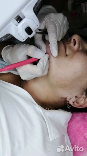 Электроэпиляция. Эпиляция. Тихорецк