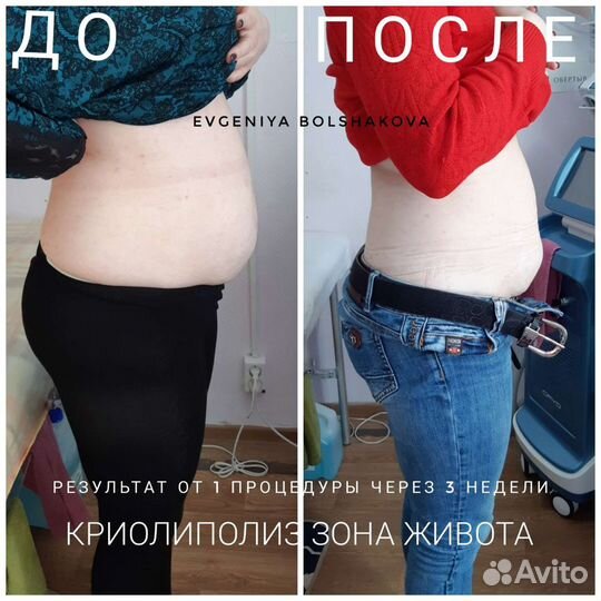 Криолиполиз