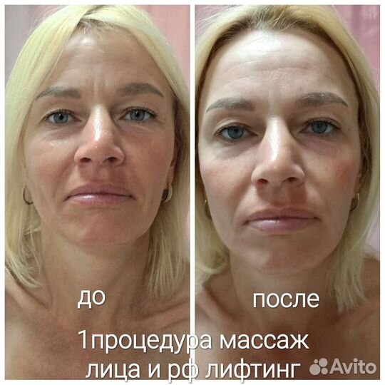 Массаж лица,Рф лифтинг лица.Микротоки