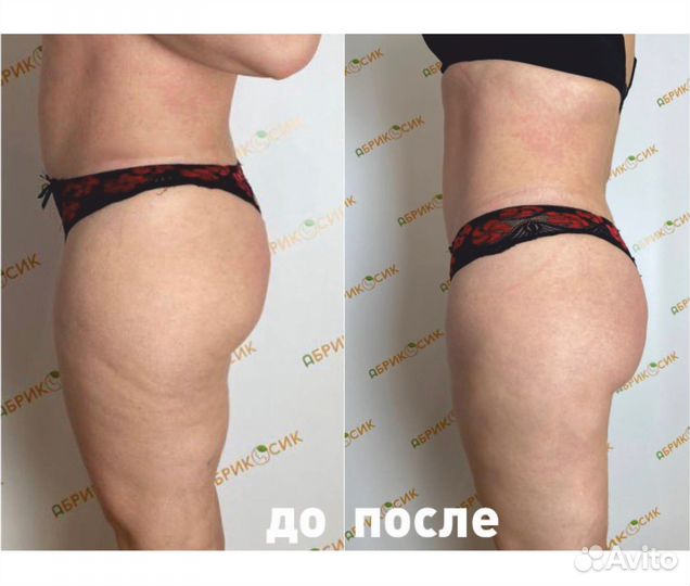 LPG массаж - похудение и лимфодренаж