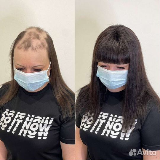 Система замещение для волос