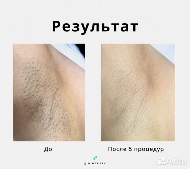 Диодный лазер Лю'Минес MaxOne 1200