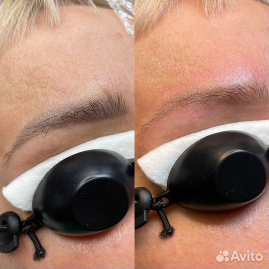 Удаление татуажа, татуировок,перманентного макияжа