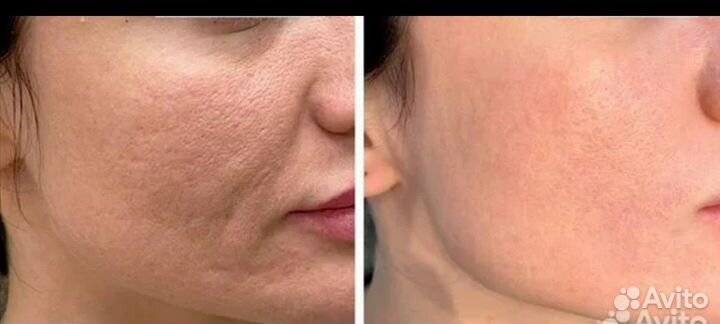 Микроигольчатый RF лифтинг