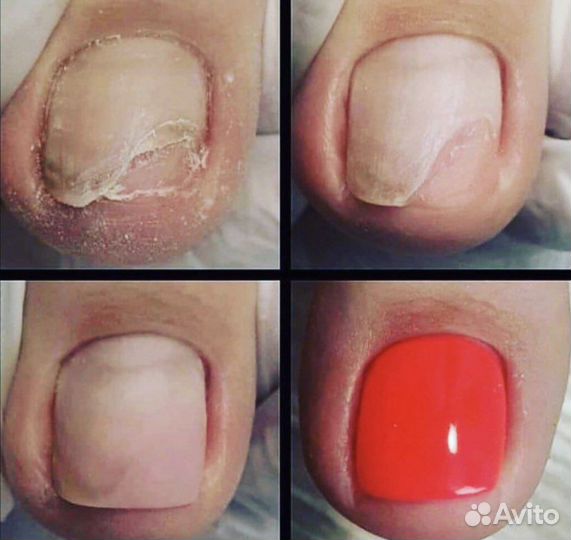 Педикюр медицинский.Титановые нити.Подолог